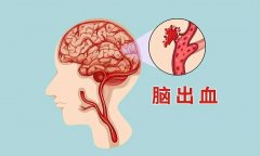 腦出血是怎么導致的原因